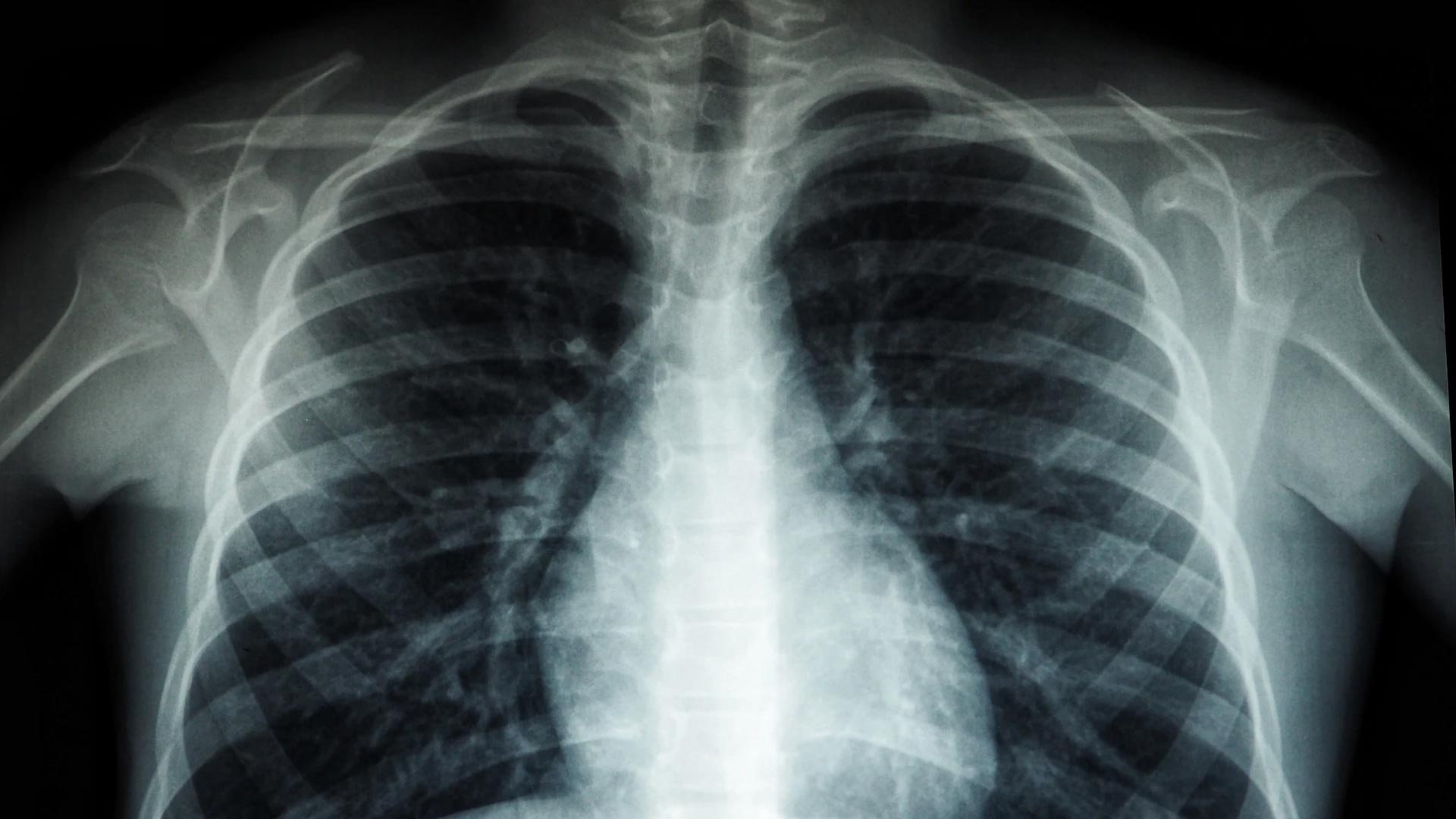an image of a chest x-ray